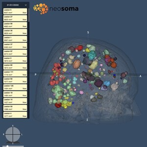 Neosoma Announces Receiving FDA 510(k) Clearance for Brain Mets