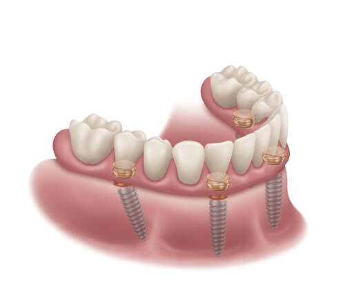 LOCATOR Fixed - implant supported dentures